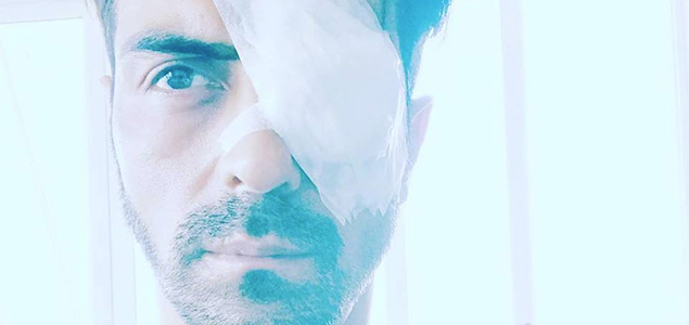 Arjun Rampal suffers eye injury